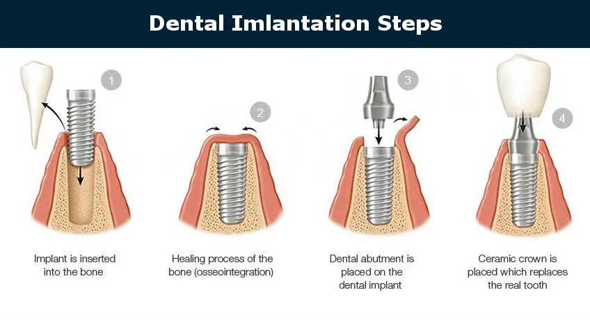 One-stage dental implant