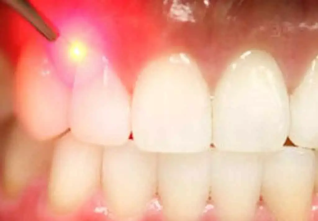 Laser Gum Treatment