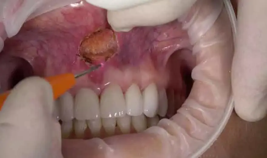 Laser Frenectomy and Tongue Tie Treatment