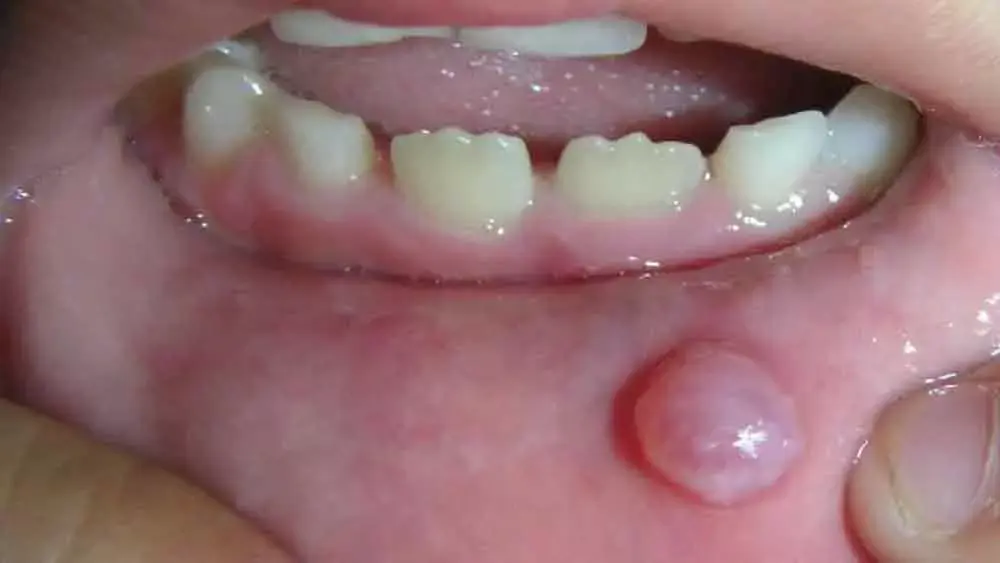 Sensitive teeth and fluoride Treatment