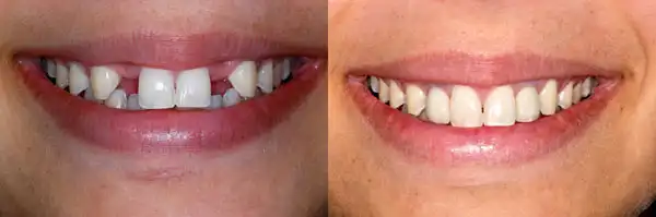Two-stage dental implant