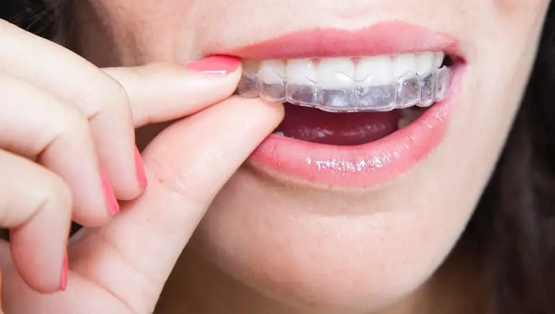 INVISALIGN and Clear Path Aligners