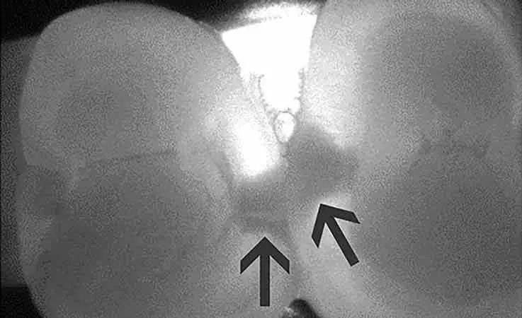 Cutting-Edge Dental Technology: Laser Decay Detection