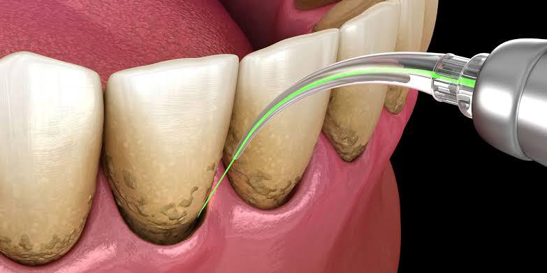 Gum disease treatment in Ryde