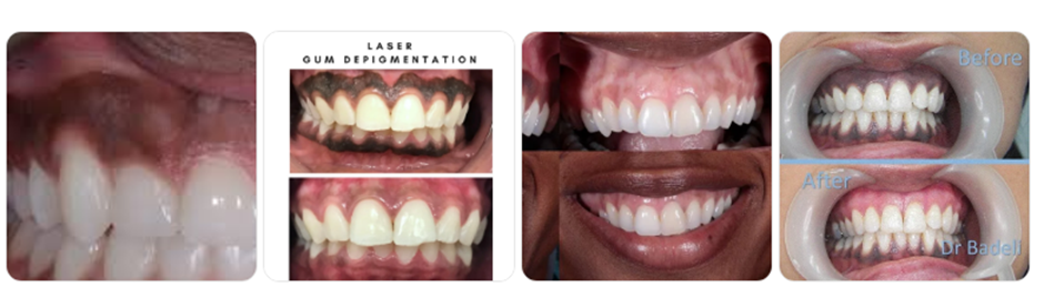 Laser Gum Depigmentation