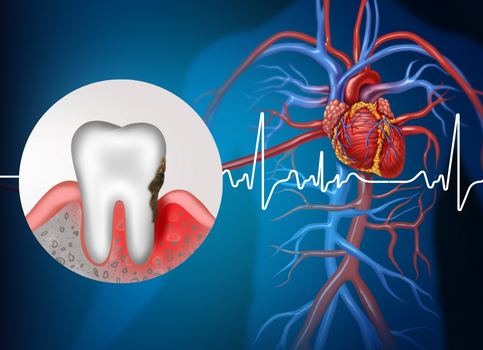 Periodontal Diseases