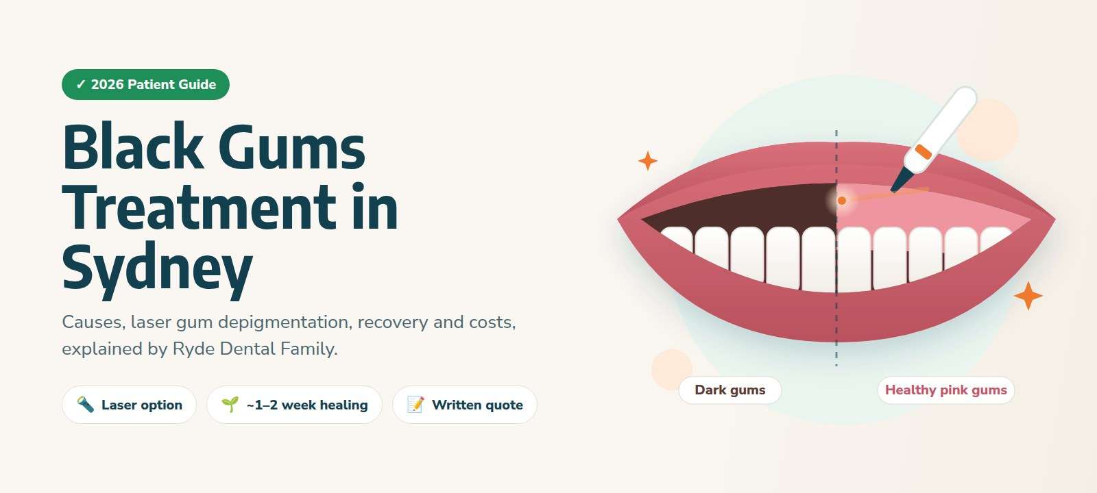 Black gums treatment in Sydney: illustration of a smile with dark gums on one side and healthy pink gums on the other after laser gum depigmentation at Ryde Dental Family