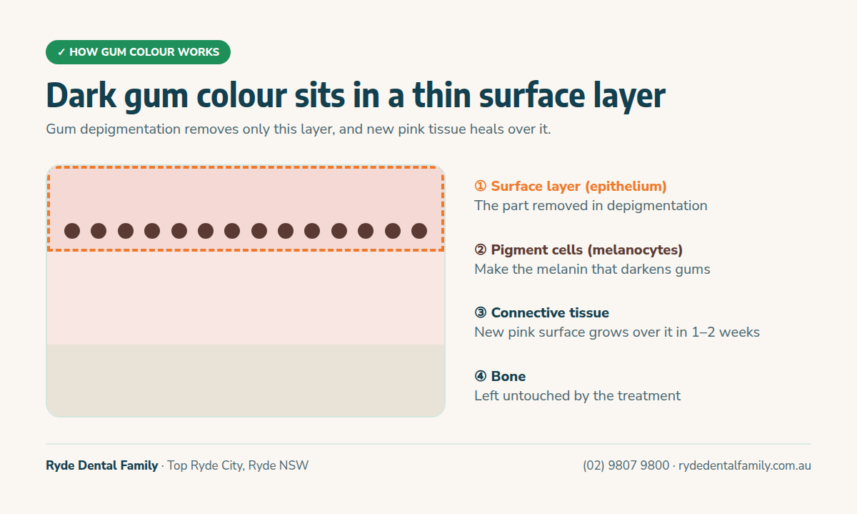 Labelled cross-section diagram of gum tissue showing the surface layer with pigment cells, the connective tissue beneath it and the bone, with the surface layer marked as the part removed in gum depigmentation